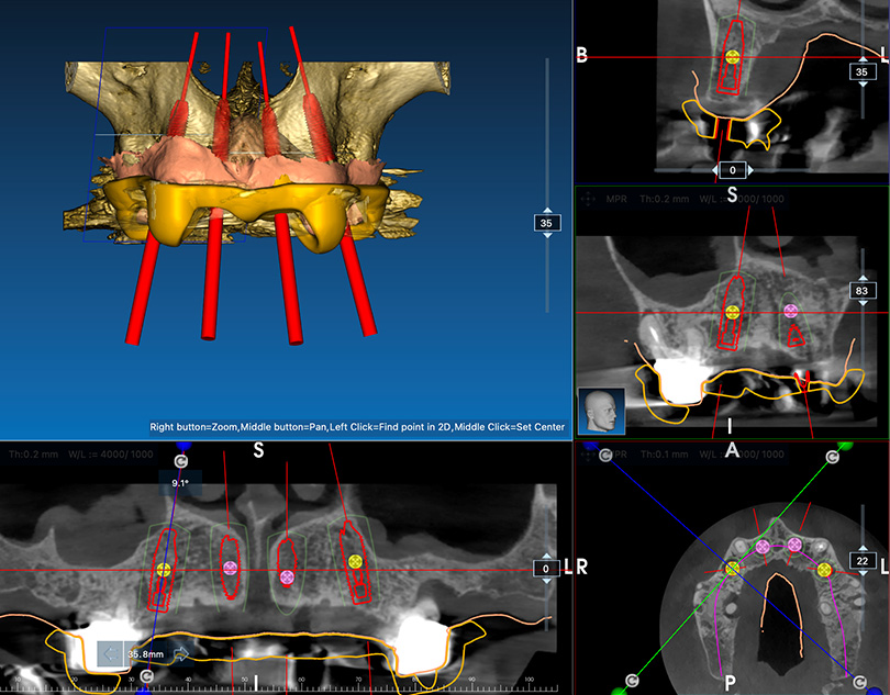 3D-Implantatplanung / -navigation